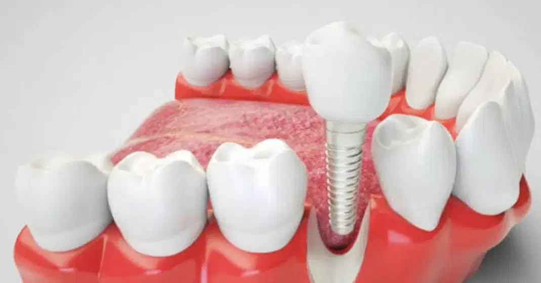 دندانپزشکی/ متخصص جراح فک ولثه /ایمپلنت 9میلیون|خدمات آرایشگری و زیبایی|مشهد, احمدآباد|دیوار