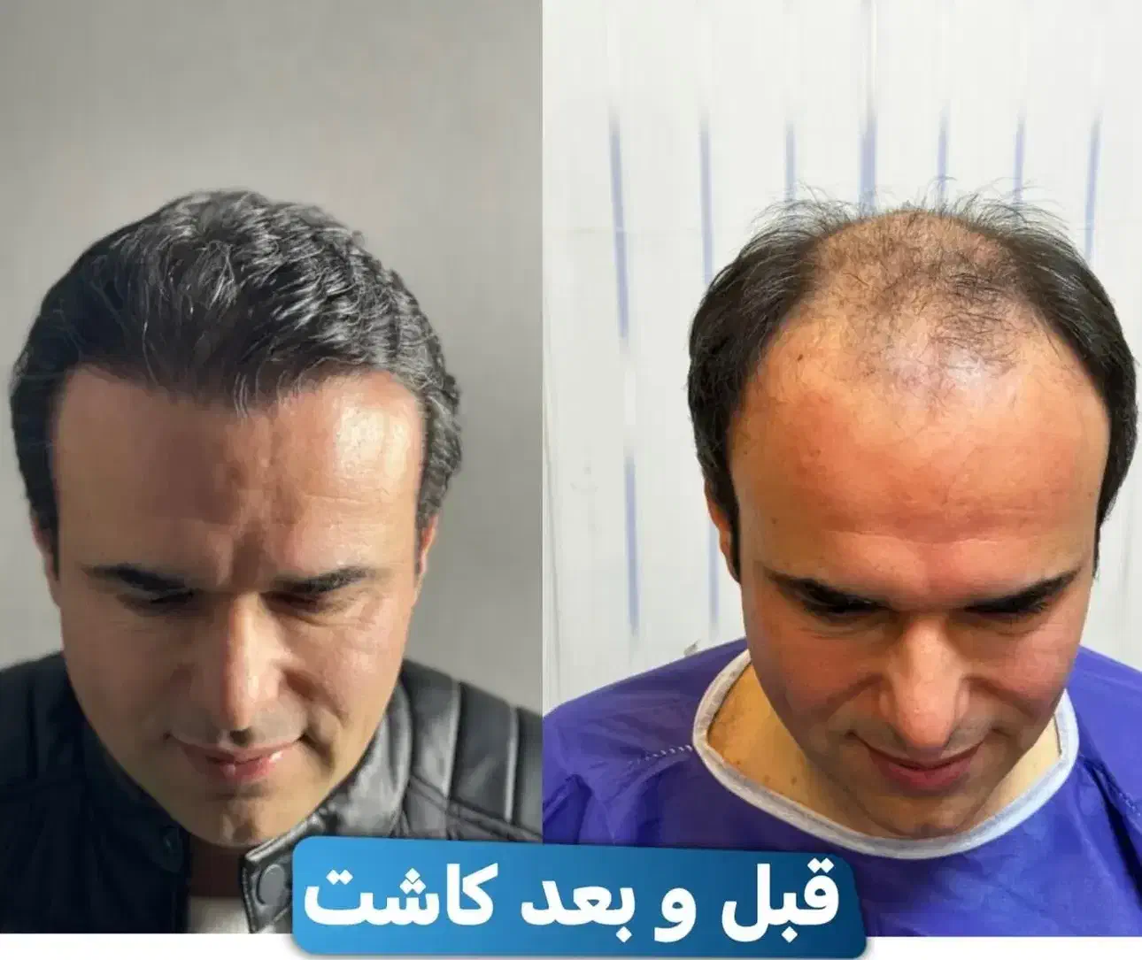 کاشت مو و ابرو|خدمات آرایشگری و زیبایی|رشت, بوسار|دیوار