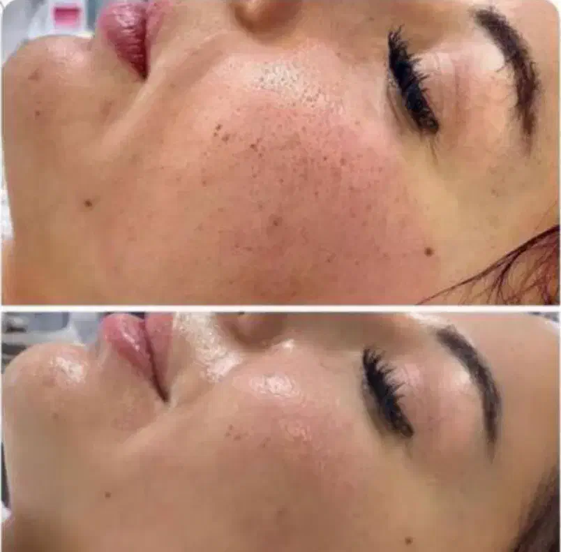 جوانسازی و پلاسماتراپی و مزونیدلینگ|خدمات آرایشگری و زیبایی|فرح آباد, |دیوار