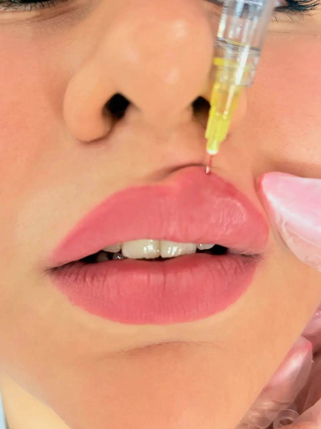 تزریق ژل و بوتاکس هایفو مزوژل|خدمات زیبایی و سلامت|تهران, شهرک شریعتی|دیوار