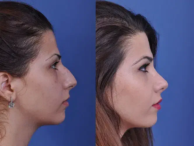 جراحی پلک(بلفاروپلاستی) / جراحی بینی/ جراحی غبغب|خدمات آرایشگری و زیبایی|شیراز, قصرالدشت|دیوار