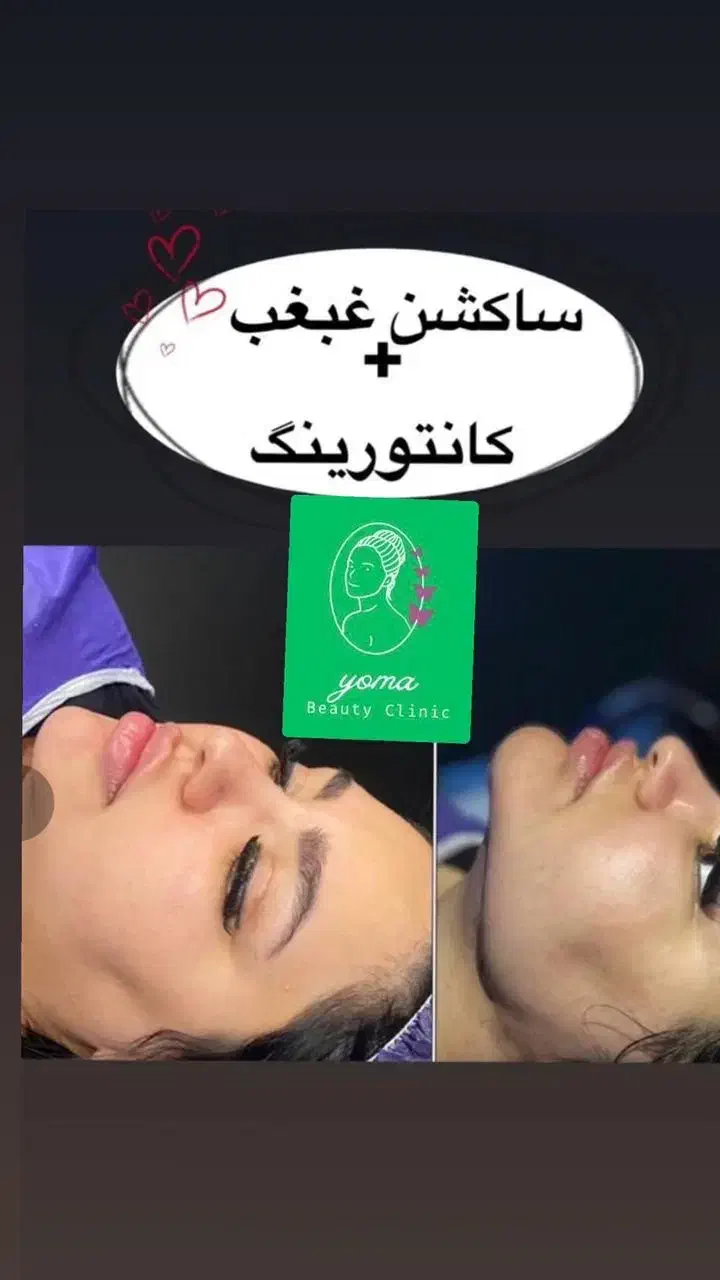 بلفارو/غبغب/سانترال/چشم گربه ایی/فیلر بادی و بکینی|خدمات آرایشگری و زیبایی|اهواز, کیانپارس |دیوار