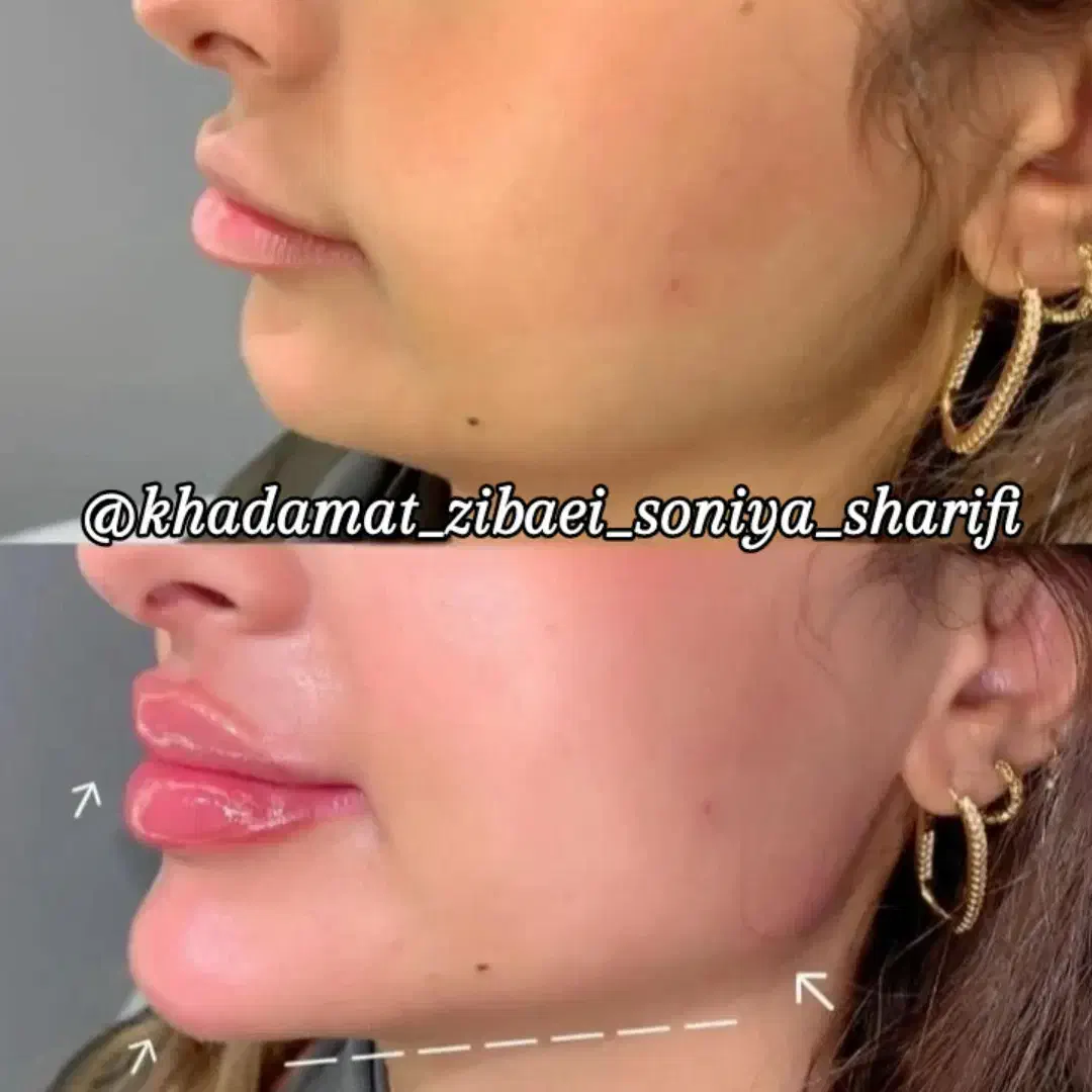 50 درصد تخفیف تزریقات ژل و بوتاکس|خدمات آرایشگری و زیبایی|اهواز, کوی رمضان|دیوار
