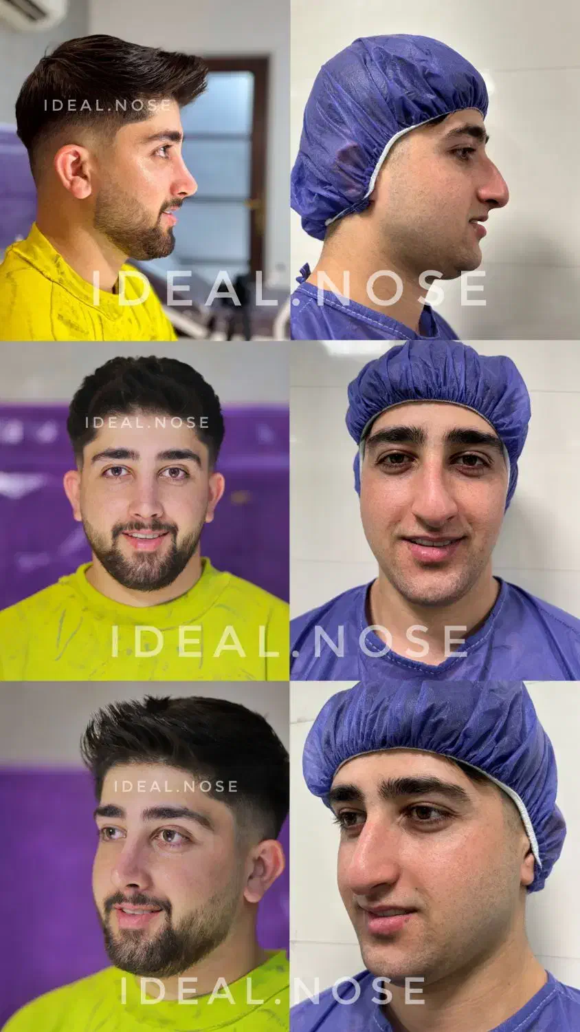 جراحی-زیبایی-بینی|خدمات آرایشگری و زیبایی|کرمانشاه, |دیوار