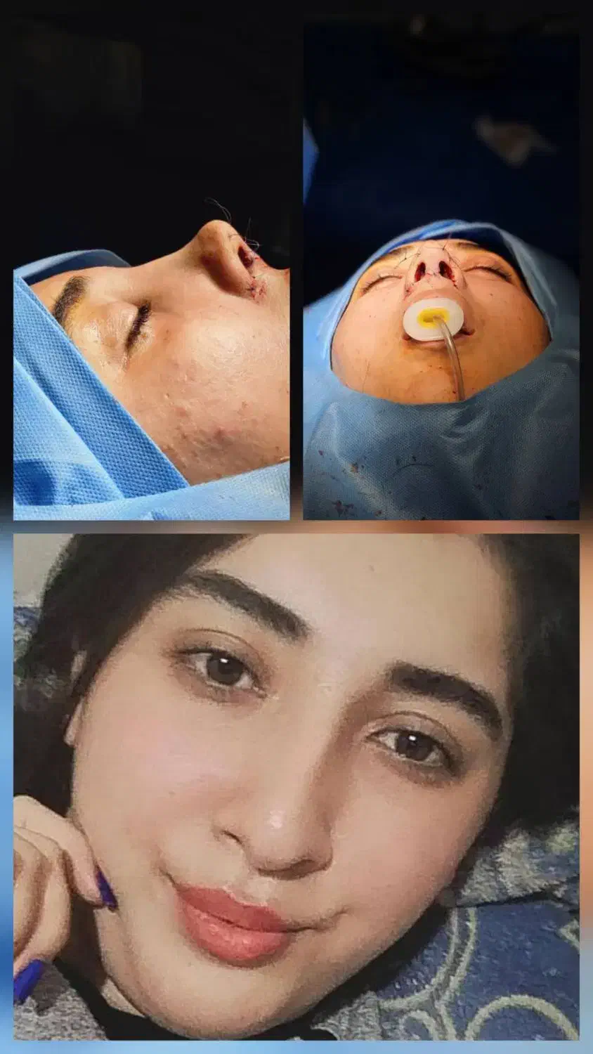 عمل زیبایی بینی 24میلیون|خدمات آرایشگری و زیبایی|قائم‌شهر, |دیوار