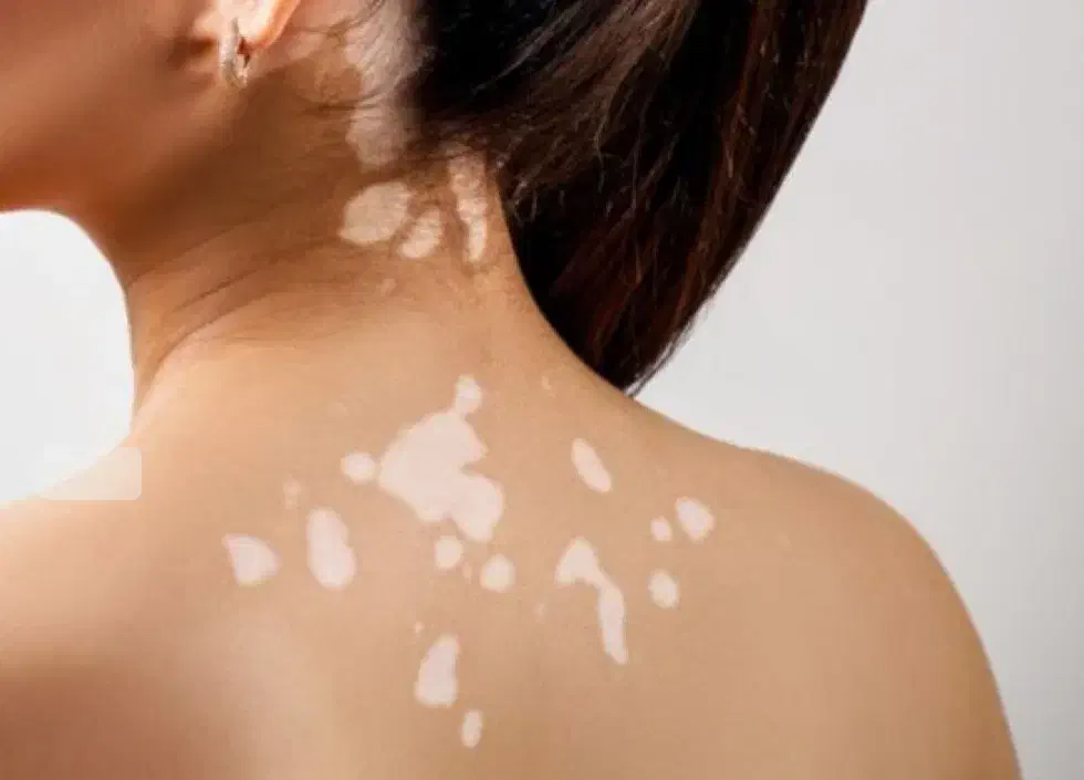 درمان انواع بیماریهای پوستی|آرایشی، بهداشتی، درمانی|شاهرود (اردبیل), |دیوار