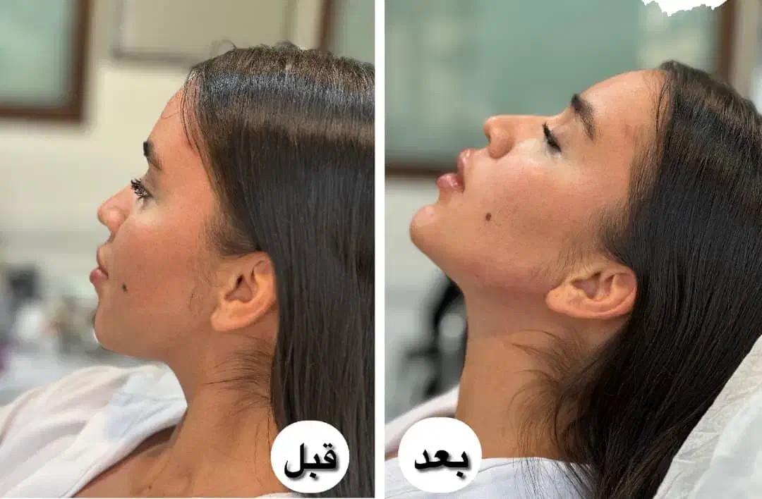 جشنواره ژل و بوتاکس و فیلر بادی و لیفت صورت|خدمات آرایشگری و زیبایی|تهران, صادقیه|دیوار