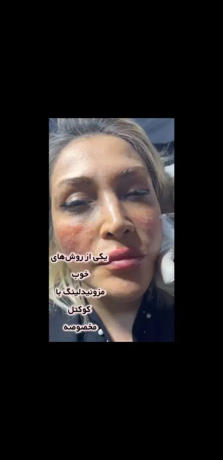 بوتاکس ژل مزوتراپی مو و صورت میکرونیدلینگ فشیال|خدمات آرایشگری و زیبایی|چهارباغ, |دیوار