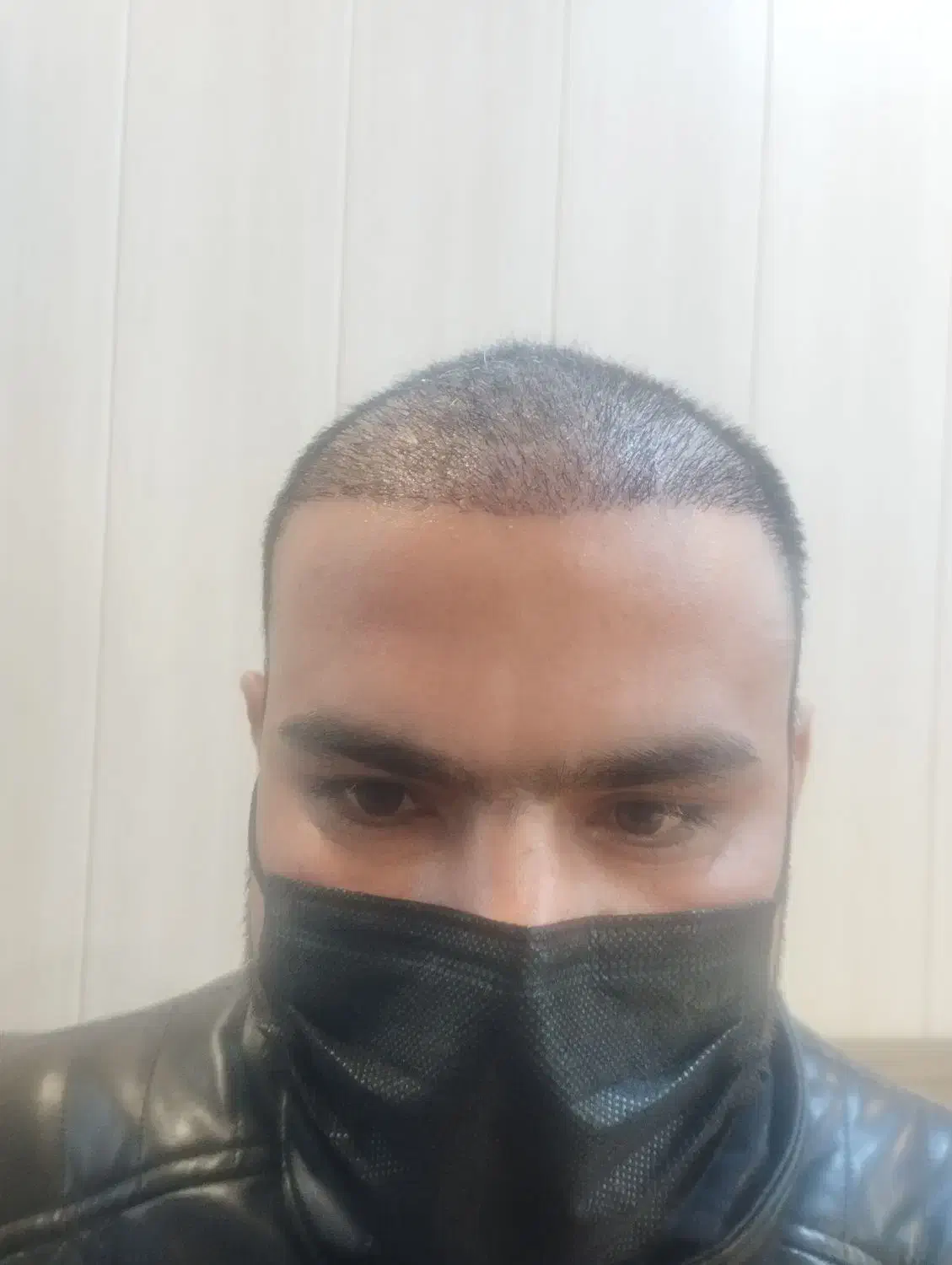 کشت مو ب روش fit|خدمات آرایشگری و زیبایی|کرمان, |دیوار