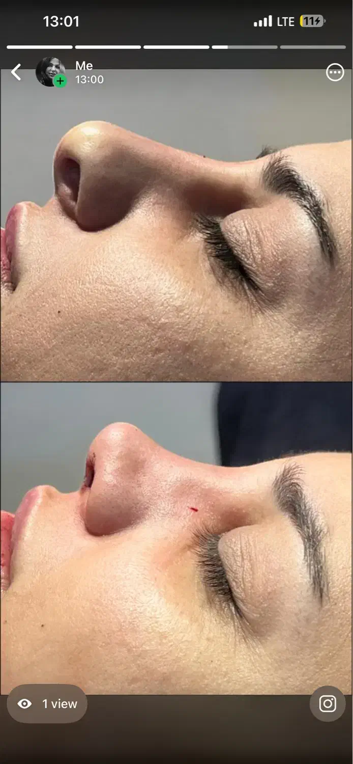 اف عمل زیبایی بینی|خدمات آرایشگری و زیبایی|دهدشت, |دیوار