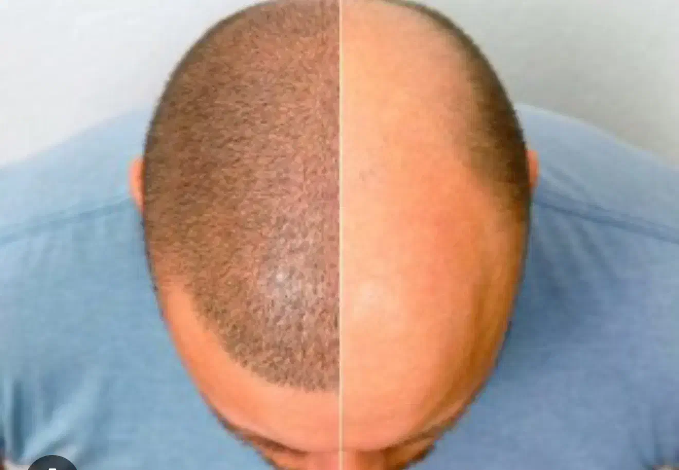 دستیار کاشت مو|استخدام درمانی، زیبایی، بهداشتی|ایلام, |دیوار