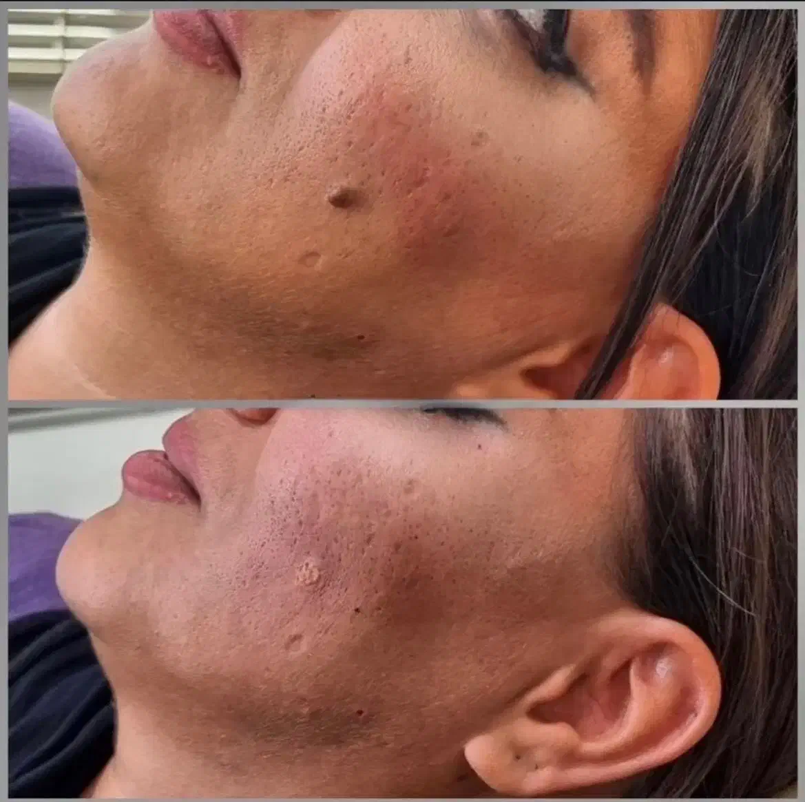 حذف خال و زگیل و رفع جای جوش و حفرات با تخفیف|خدمات آرایشگری و زیبایی|تهران, بیسیم|دیوار