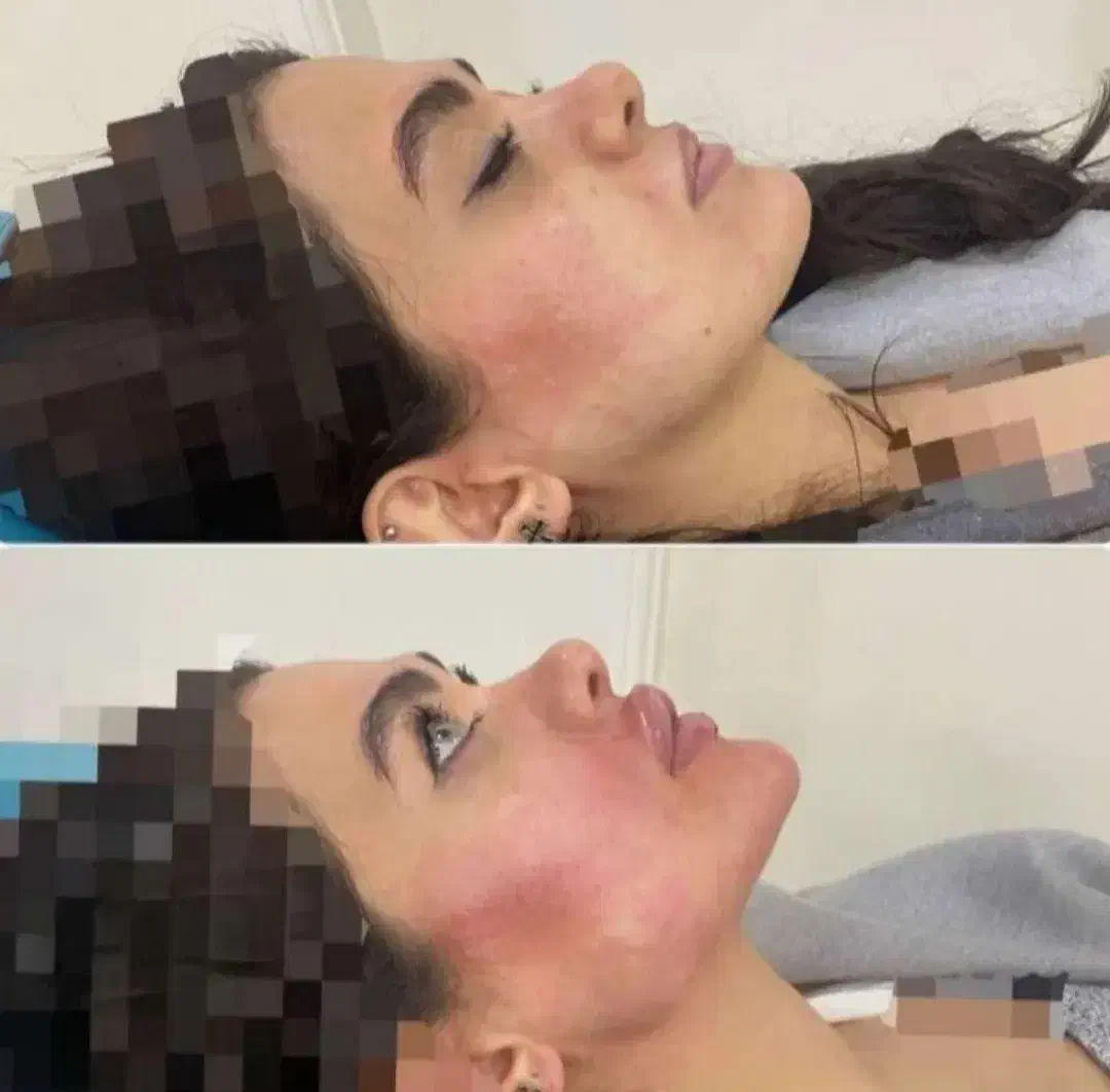 تزریق فیلر،ژل،بوتاکس|خدمات آرایشگری و زیبایی|کرمانشاه, |دیوار