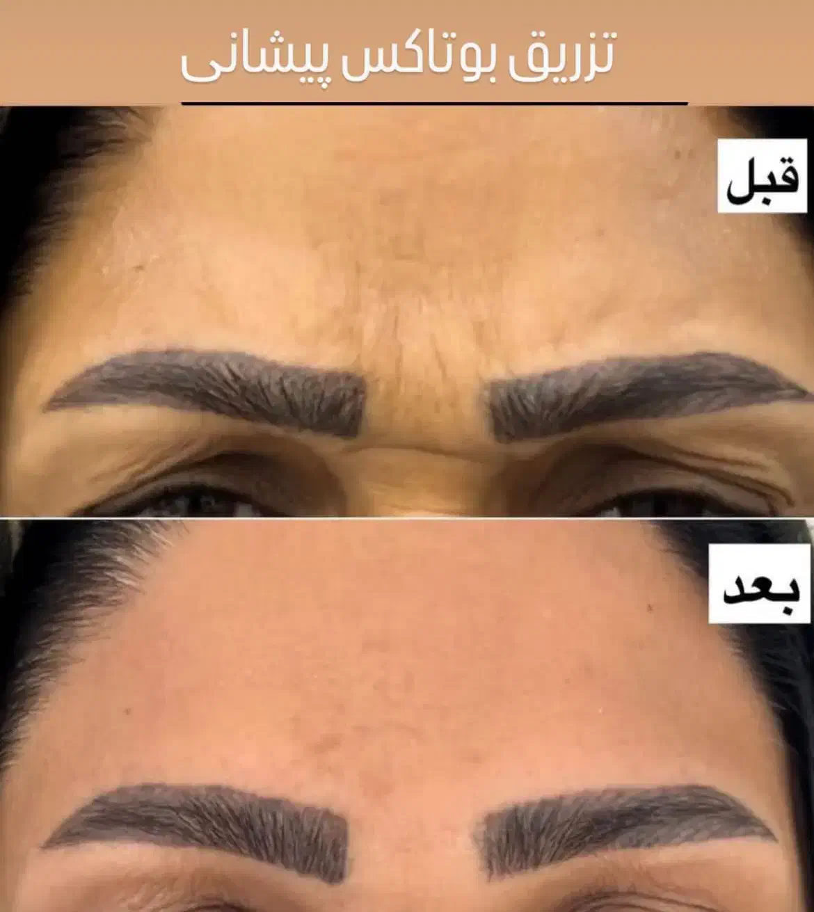 جشنواره بوتاکس و مزو به مدت محدود|خدمات آرایشگری و زیبایی|اصفهان, گلزار|دیوار