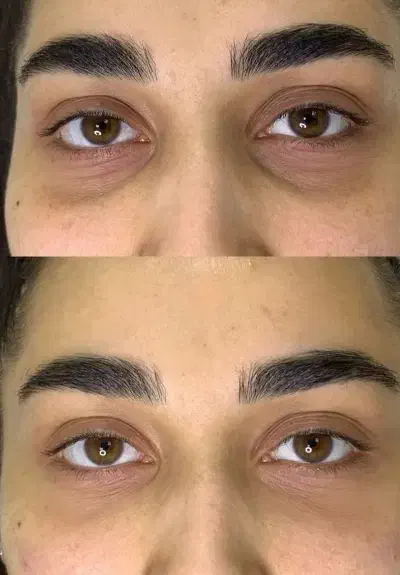 فیلر زیر چشم تا ۱۵ دی ماه فقط با ۱۸۰۰ هزارتومان|خدمات آرایشگری و زیبایی|همدان, |دیوار