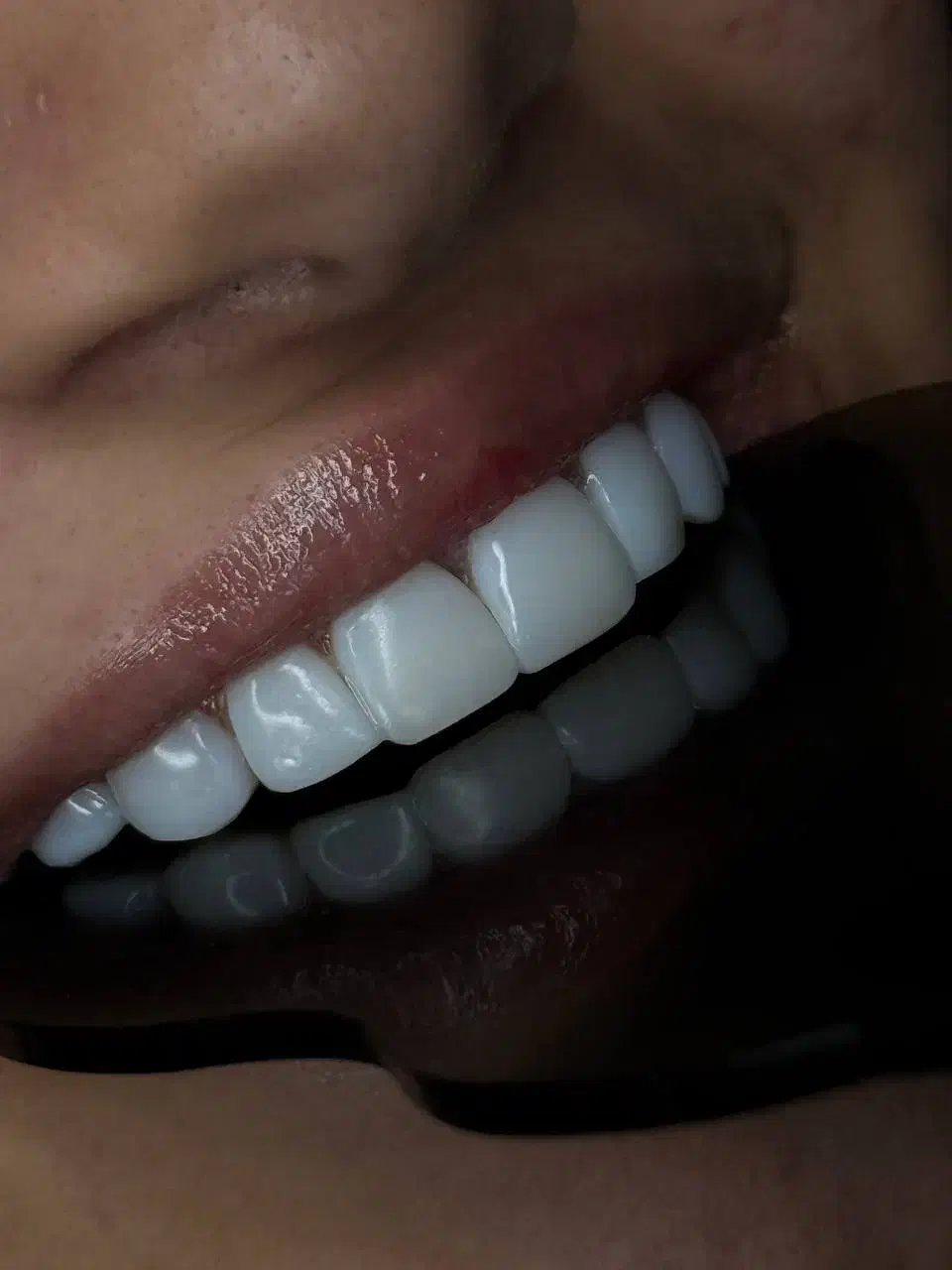 جشنواره کامپوزیت لمینیت روکش عصب ترمیم IMAX IPS|خدمات آرایشگری و زیبایی|تهران, هفت حوض|دیوار