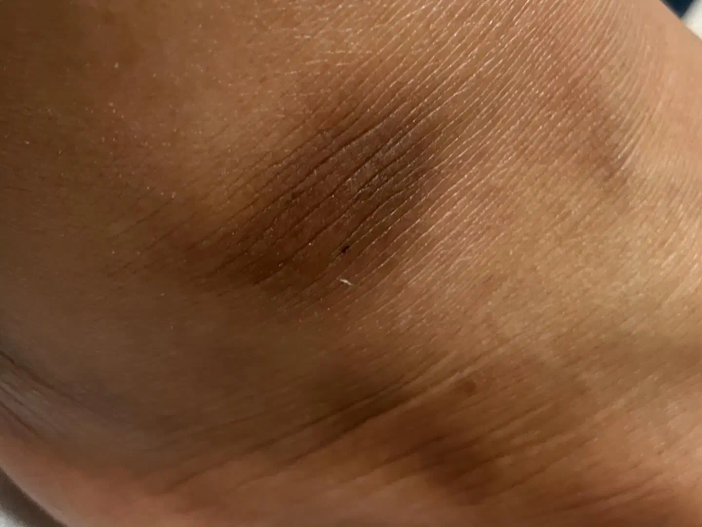 درمان تیرگی های بدن|آرایشی، بهداشتی، درمانی|مشهد, چهارچشمه|دیوار