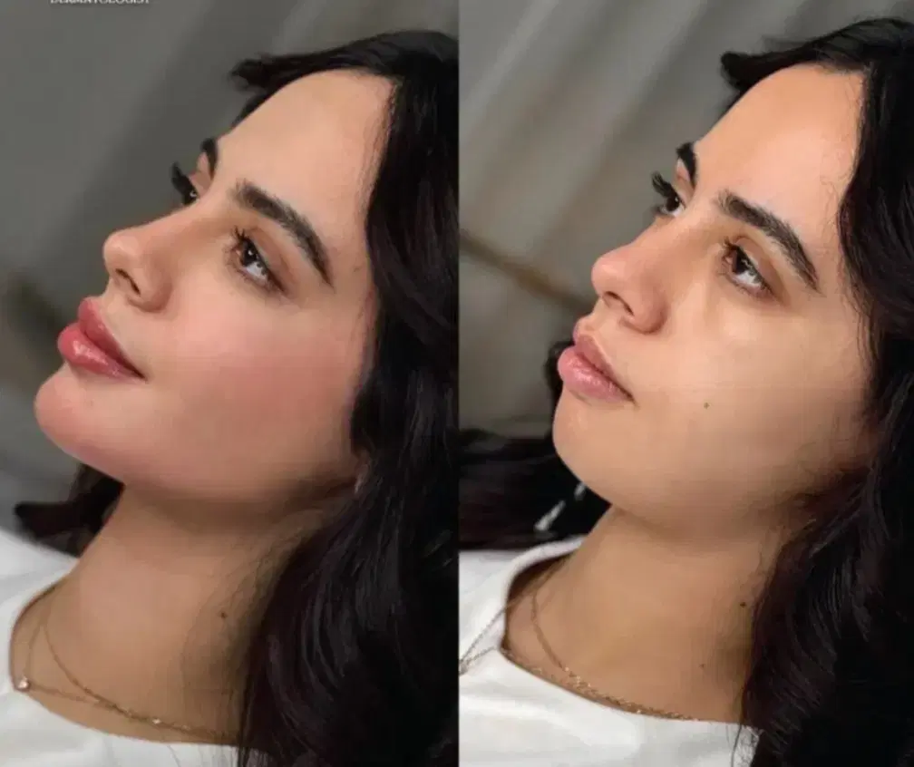 تخفیف ژل بوتاکس مزو آنزیم|خدمات زیبایی و سلامت|کرمانشاه, |دیوار