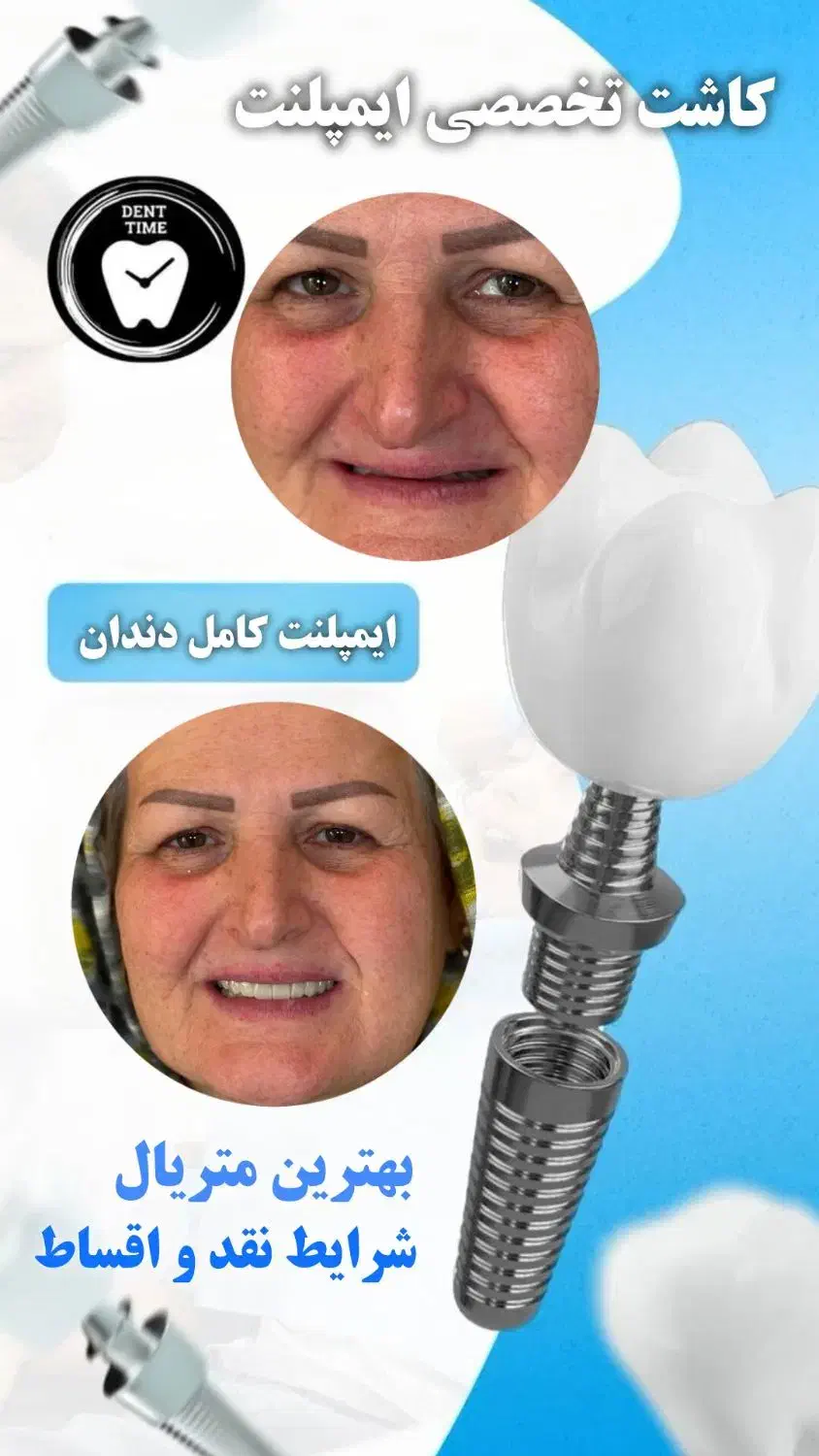 کاشت اقساطی ایمپلنت دندان (با ۱۰ تومن شروع کن)|خدمات آرایشگری و زیبایی|رشت, گلسار|دیوار