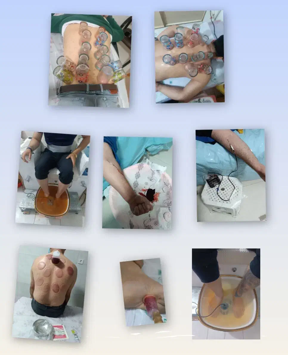 حجامت و بادکش درمانی (تحت نظر پزشک)|خدمات آرایشگری و زیبایی|خرم‌آباد, |دیوار