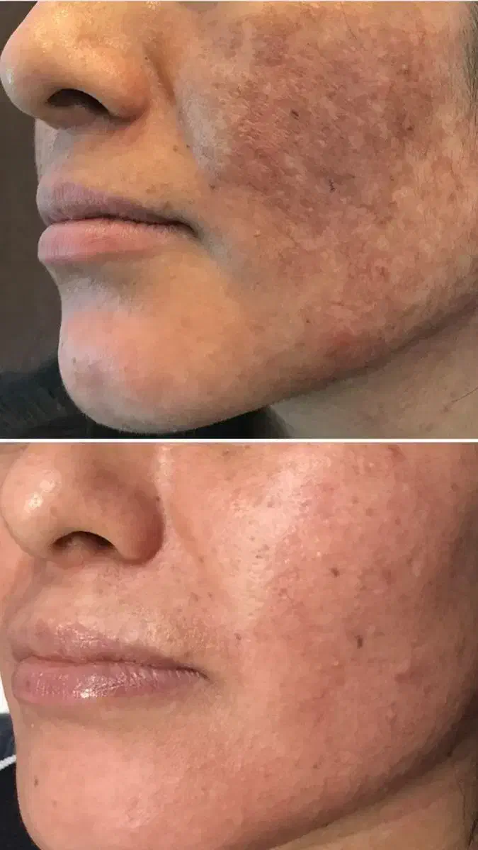 از بین بردن انواع لک صورت|خدمات آرایشگری و زیبایی|فردیس, فردیس|دیوار