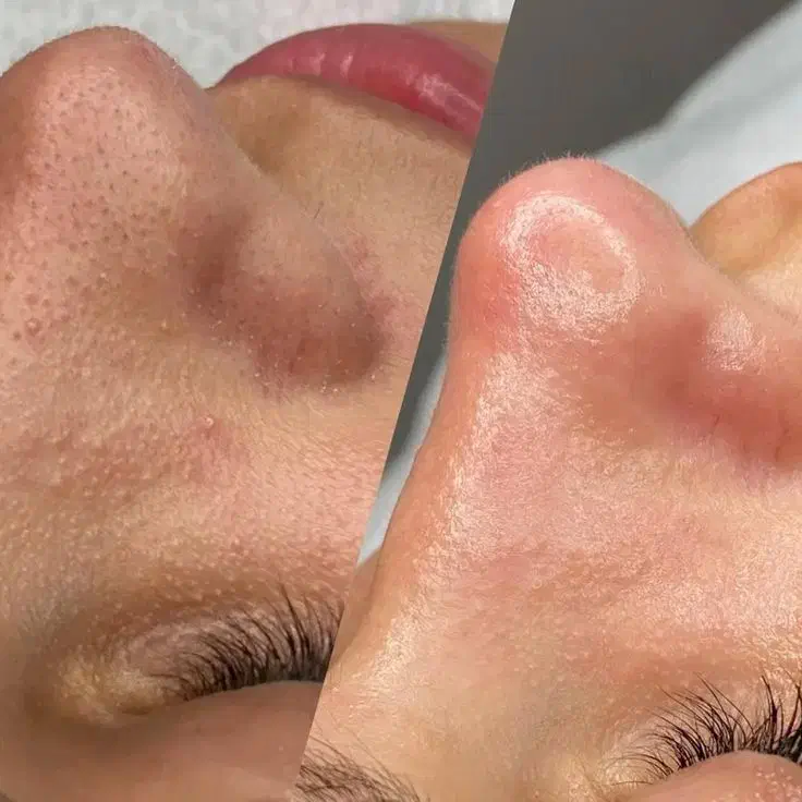 درماپلینیگ درما پاکسازی|خدمات آرایشگری و زیبایی|زابل, |دیوار