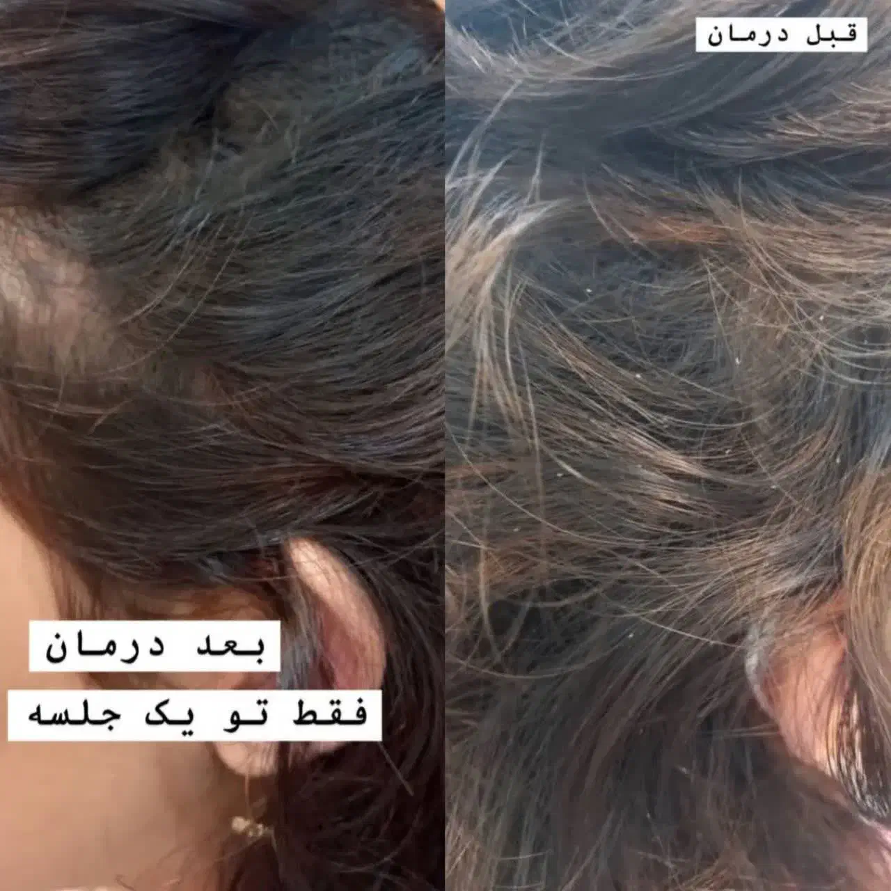 درمان رشک و شپش زیر نظر استاد حرفه ای|خدمات آرایشگری و زیبایی|قم, نیروگاه|دیوار