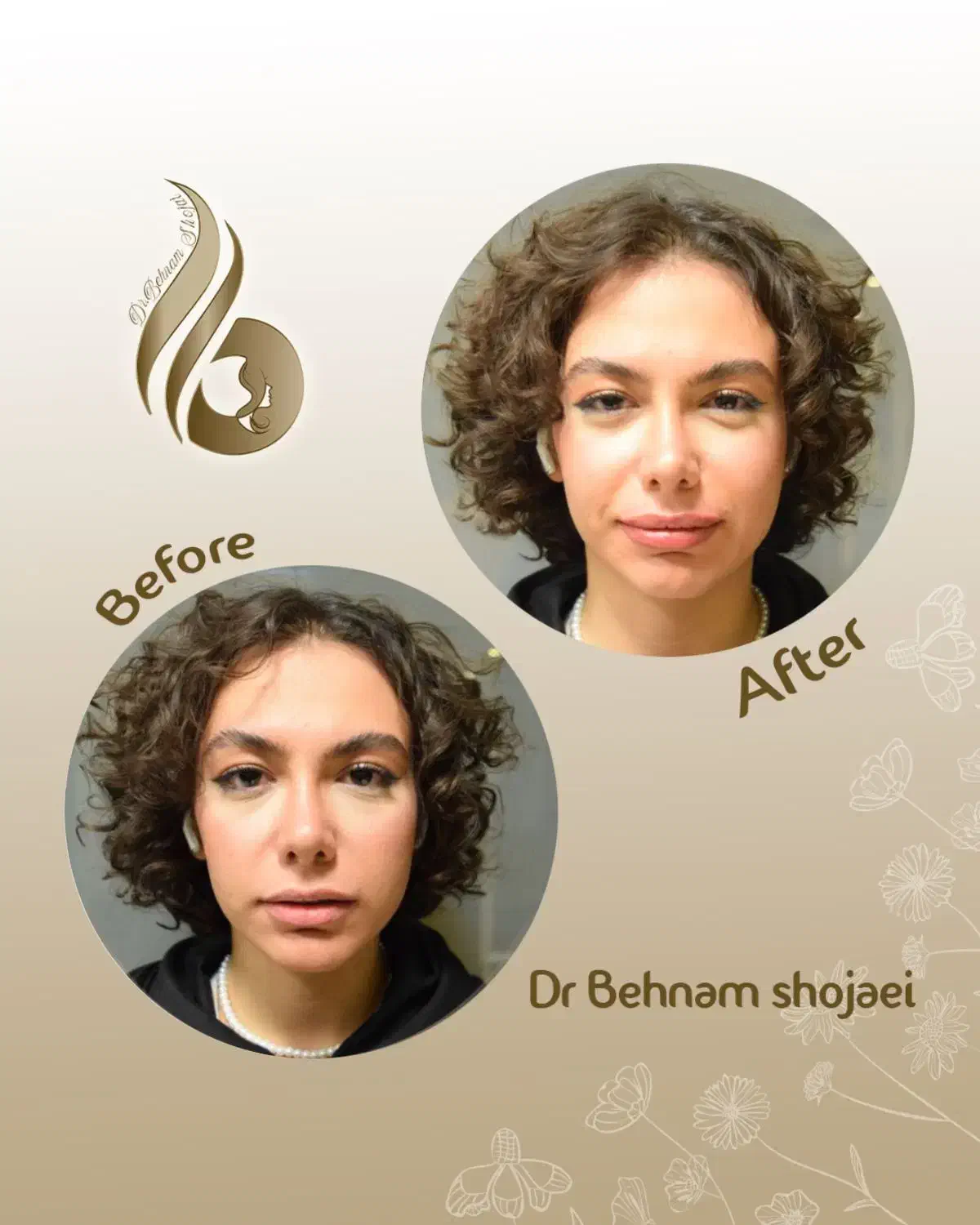 متقاضی مدل فیلر بوتاکس لیفت نخ|خدمات آرایشگری و زیبایی|تهران, دروس|دیوار