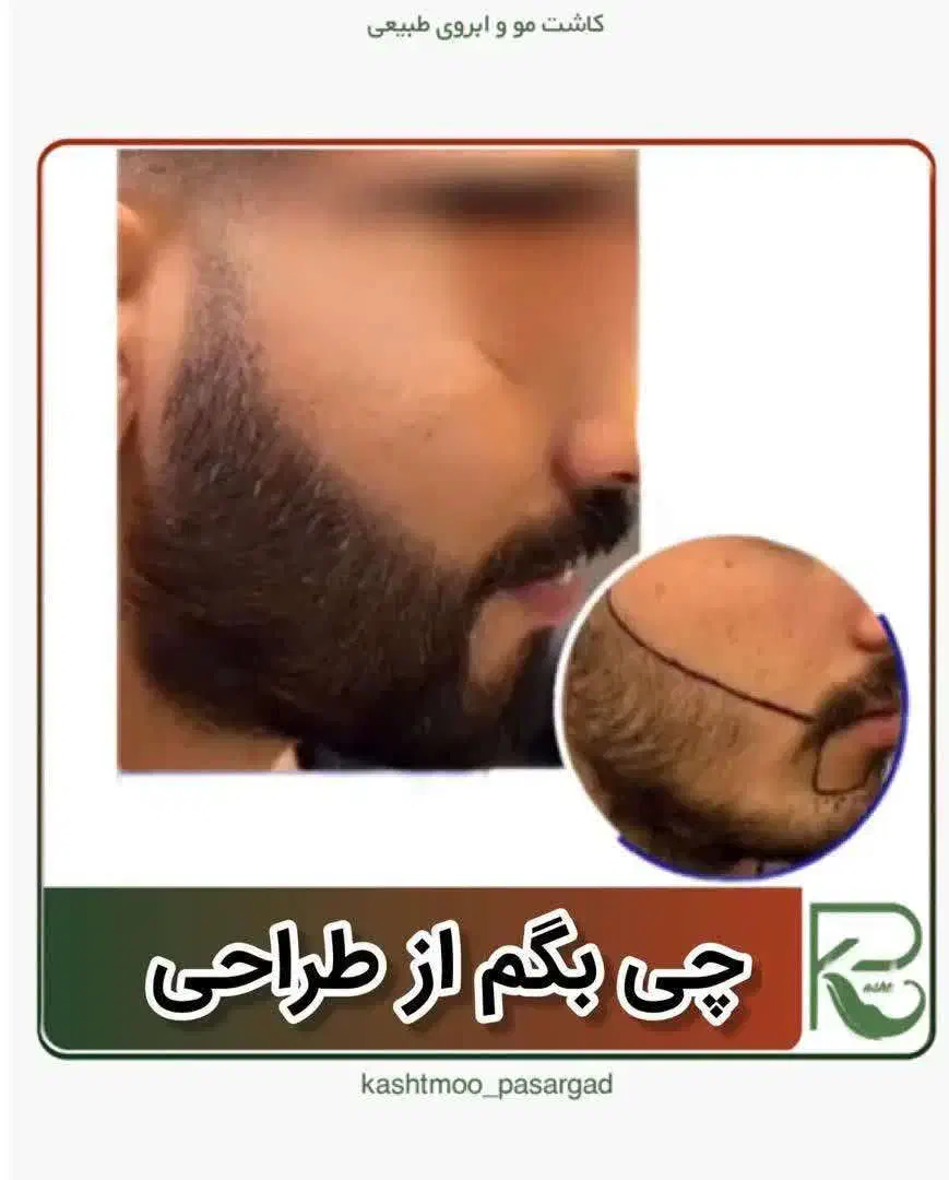 کاشت مو ابرو ریش تارکوب|خدمات آرایشگری و زیبایی|بیجار, |دیوار