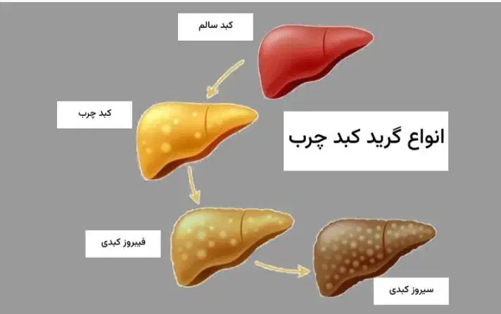 درمان مشکلات کبد|آرایشی، بهداشتی، درمانی|گوراب زرمیخ, |دیوار