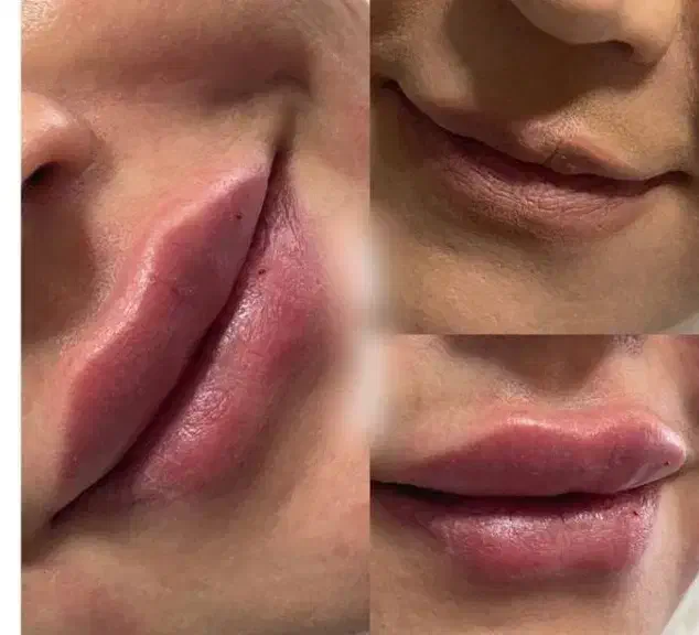 مدل ژل لب گونه چونه زاویه خط خنده ۴۰۰ ت|خدمات آرایشگری و زیبایی|قم, تولید دارو و یخچال|دیوار
