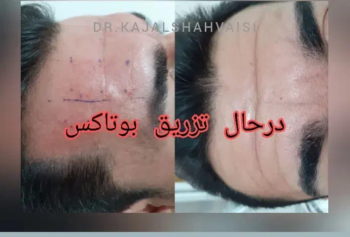 مطب زیبایی دکتر کژال شاه ویسی تزریق ژل بوتاکس..|خدمات آرایشگری و زیبایی|سنندج, |دیوار