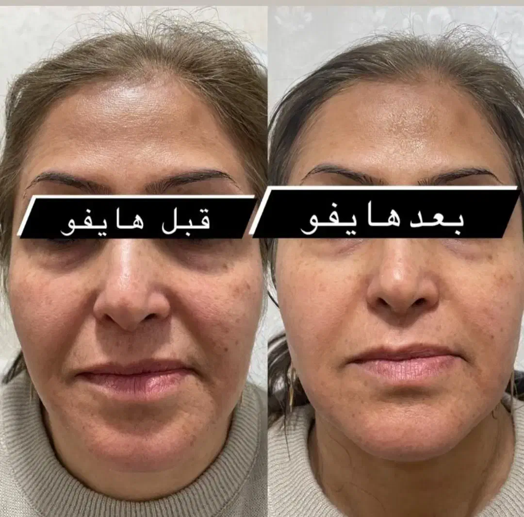 جشنواره  هایفو جوانساز  لیفت پوست|خدمات آرایشگری و زیبایی|اهواز, نادری|دیوار