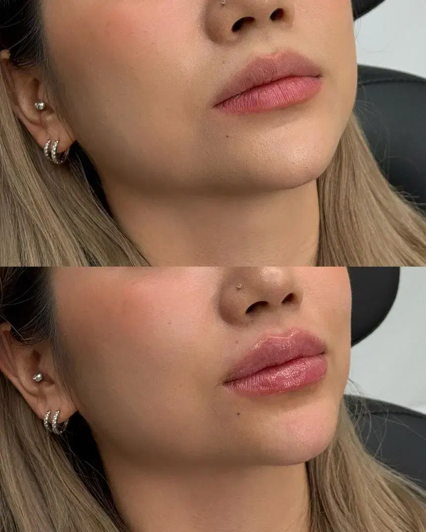 تزریق ژل چربی بوتاکس جوان ساز مزو پی آرپی|خدمات آرایشگری و زیبایی|رشت, گلسار|دیوار