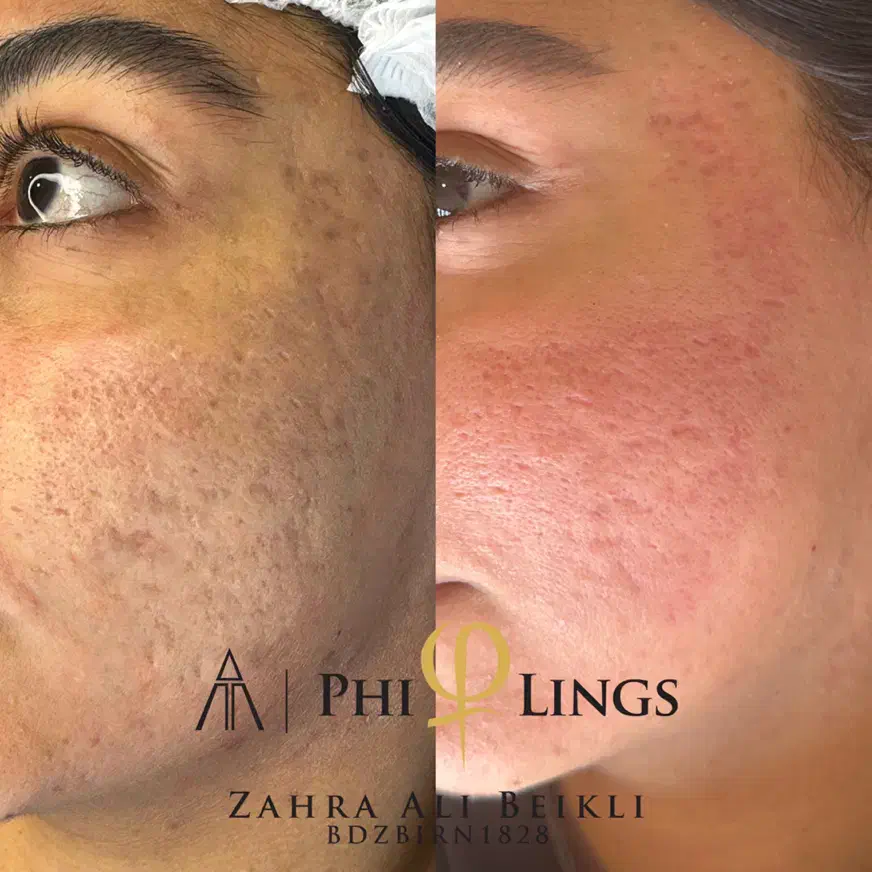 رفع تخصصی جای جوش|خدمات آرایشگری و زیبایی|تهران, قبا|دیوار