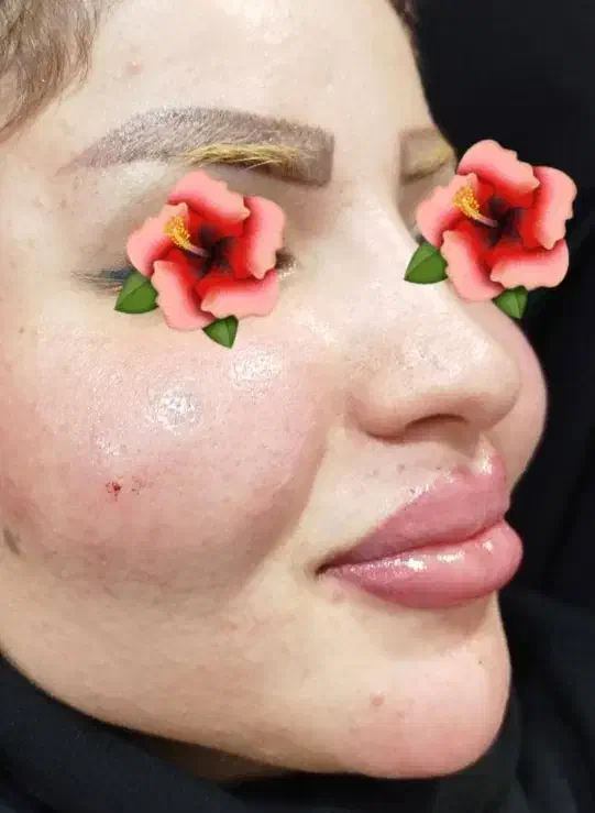 ژل سی سی۵۰۰ پرسینگ، چال گونه|خدمات آرایشگری و زیبایی|اهواز, کمپلو جنوبی|دیوار