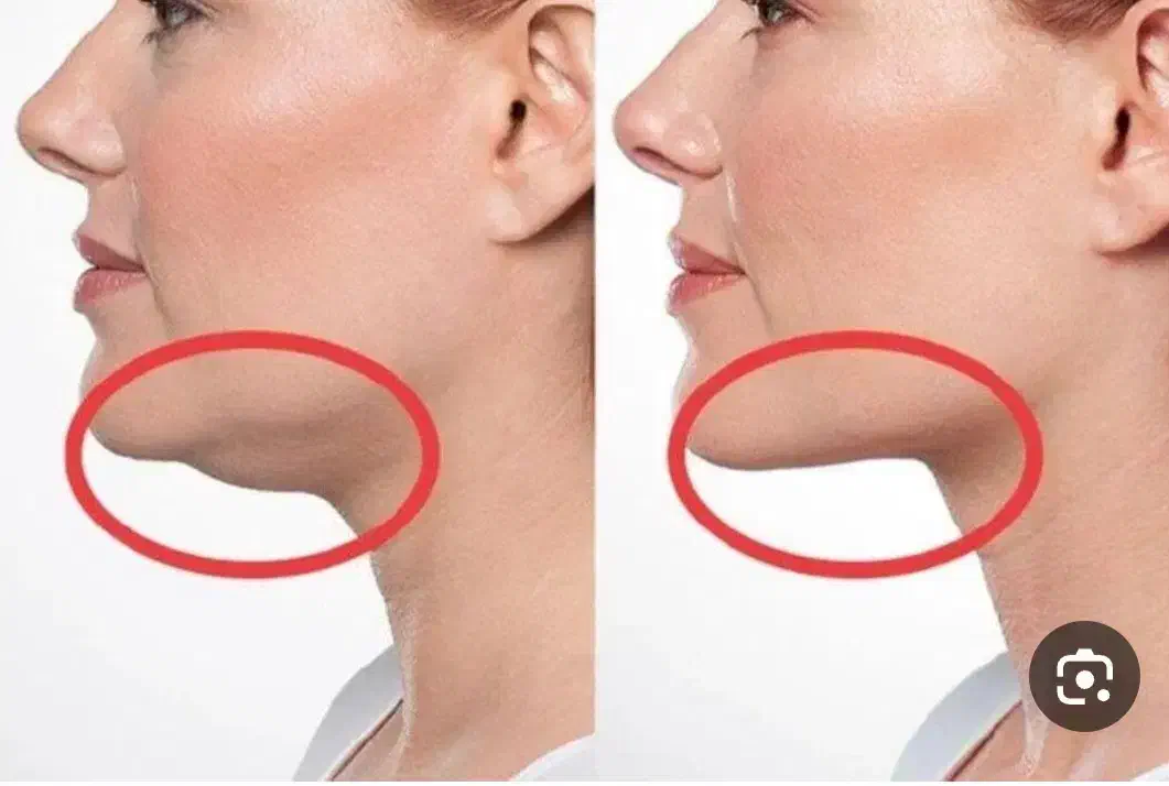 پیکرتراشی ساکشن غبغب بلفاروپلاستی ۵۰ درصد تخفیف|خدمات آرایشگری و زیبایی|اصفهان, باغ نگاره|دیوار