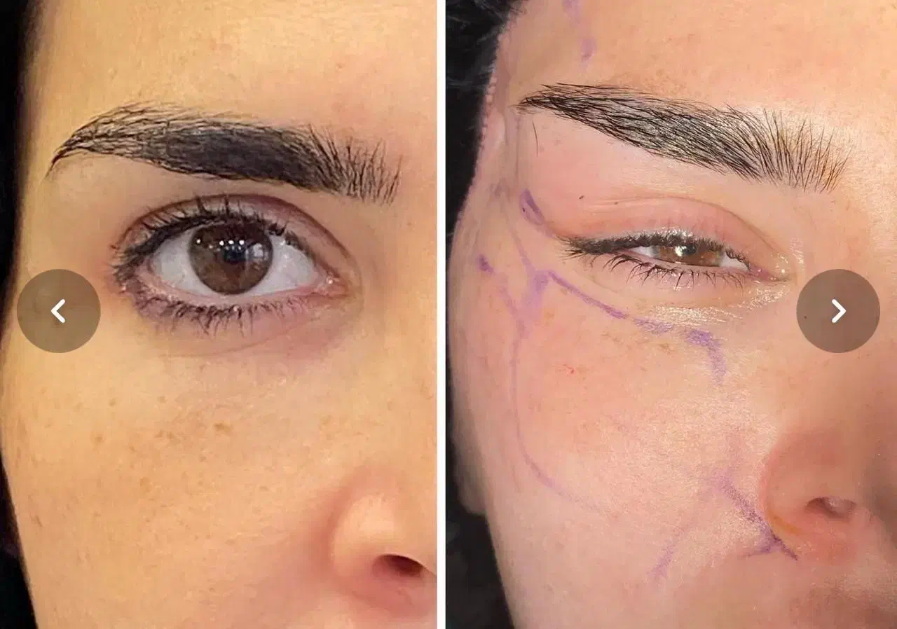 بلفارو/غبغب/سانترال/چشم گربه ایی/فیلر بادی و بکینی|خدمات آرایشگری و زیبایی|اهواز, کیانپارس |دیوار