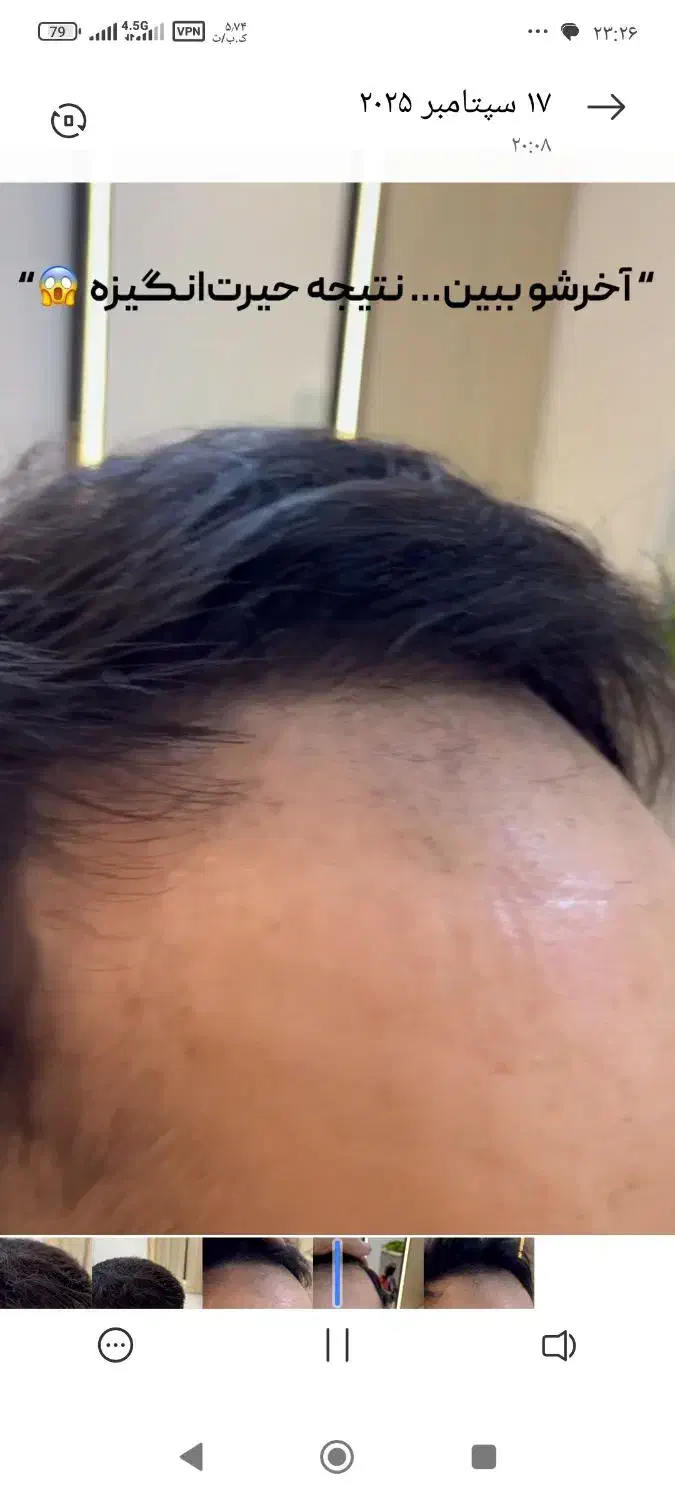 پروتز و ترمیم موی افشان|خدمات آرایشگری و زیبایی|مشهد, کوثر|دیوار