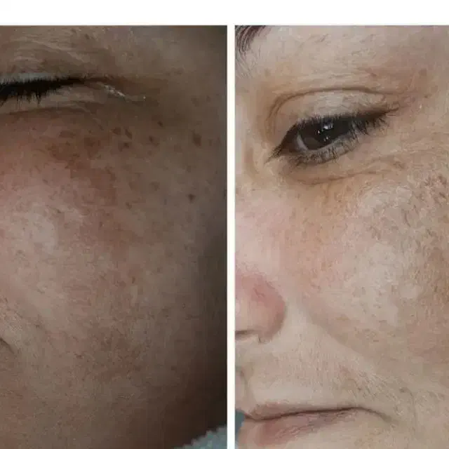 درمان تخصصی لک بدون لیزر|آرایشی، بهداشتی، درمانی|بوشهر, |دیوار