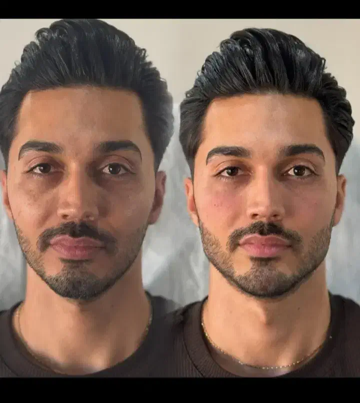 جشنواره ی پاییزه ی فیلر وبوتاکس|خدمات آرایشگری و زیبایی|ارومیه, |دیوار