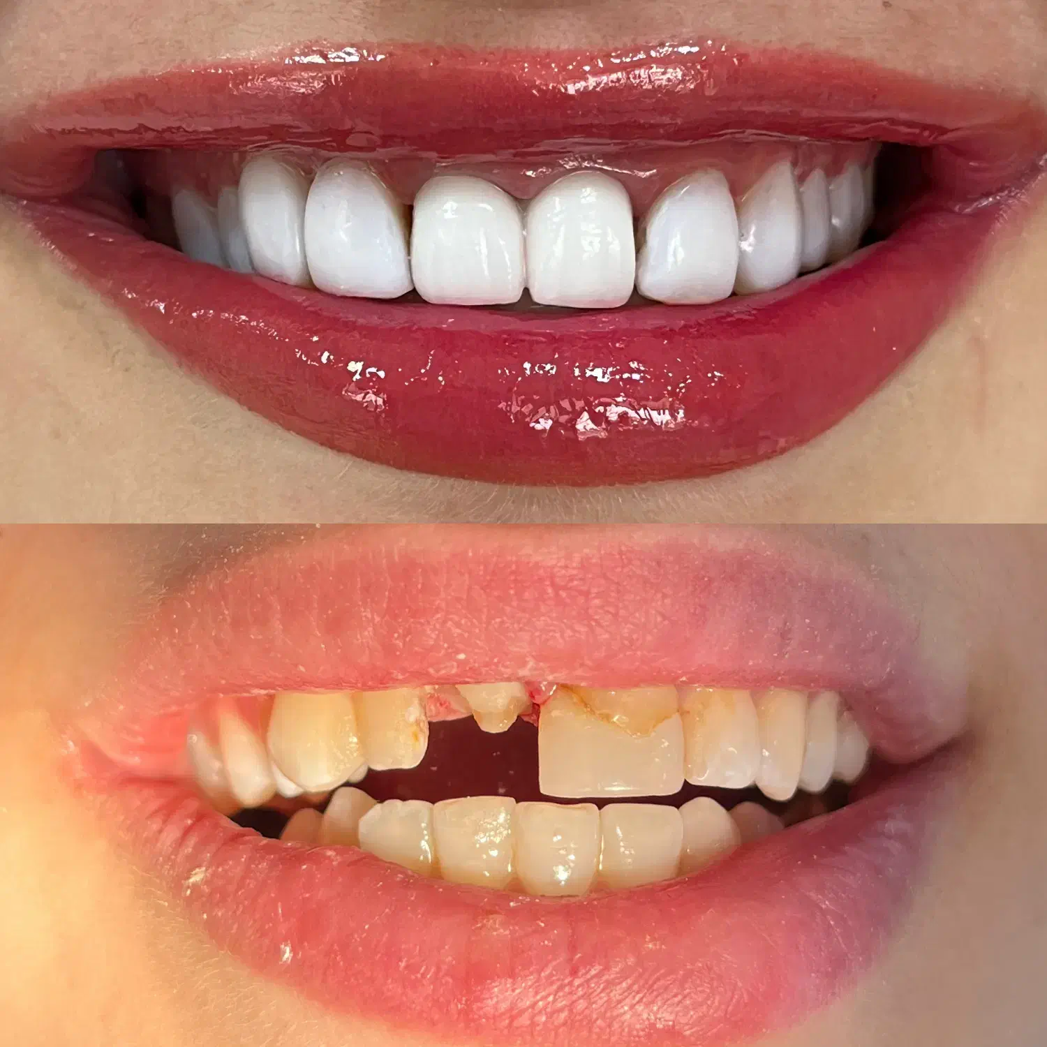 ونیر کامپوزیت ژاپنی اصل (تعرفه دولتی + اقساط)|خدمات آرایشگری و زیبایی|علیآباد کتول, |دیوار