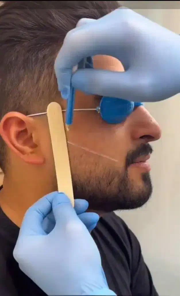 لیزر موهای زائد بدن|خدمات آرایشگری و زیبایی|تهران, کیانشهر|دیوار