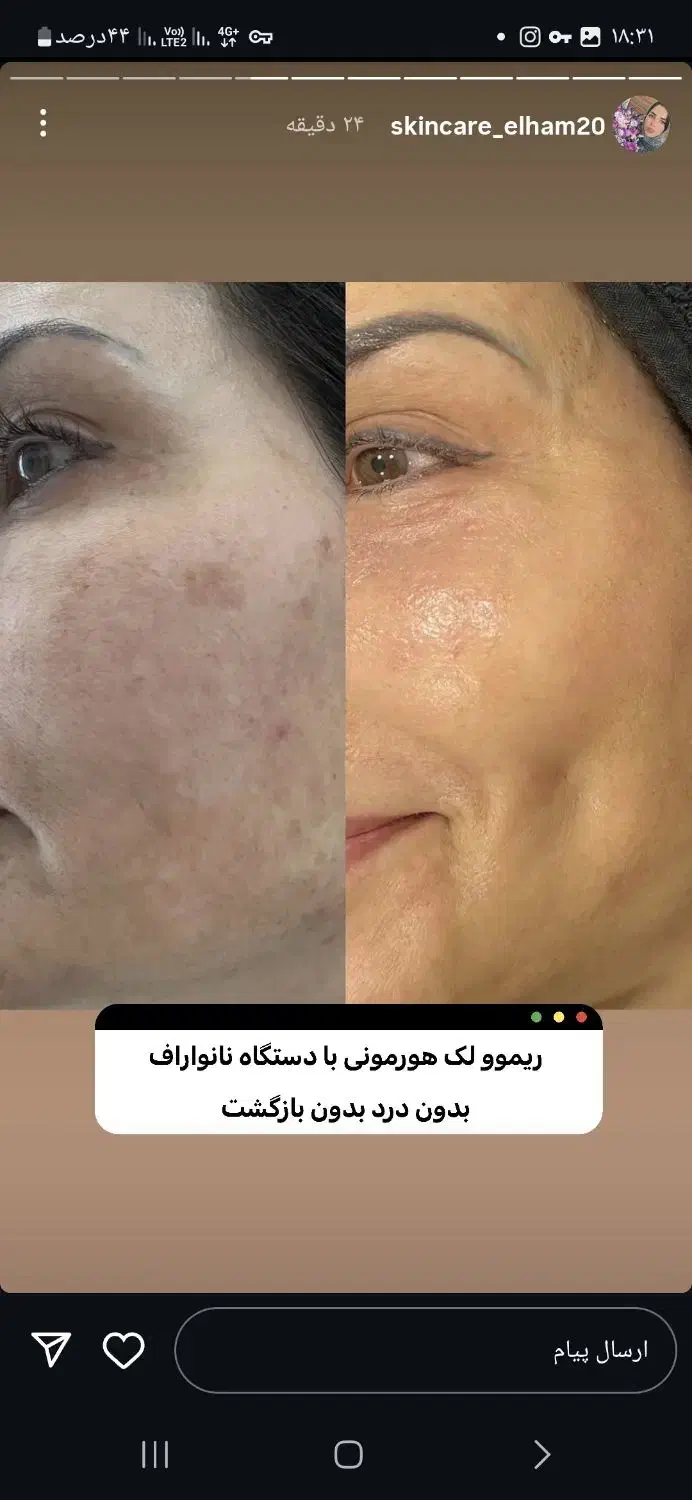 پاکسازی پوست ودرمان لک|خدمات آرایشگری و زیبایی|امیدیه, |دیوار