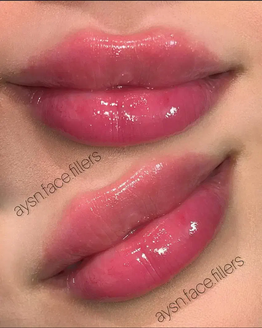 تزریق ژل و بوتاکس  تخفیف ویژه تا اخر هفته جدید|خدمات آرایشگری و زیبایی|گنبد کاووس, |دیوار