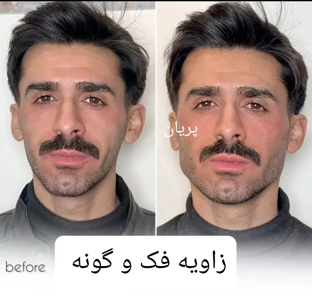 جشنواره فیلر فول فیس ژل بوتاکس نخ هایفو بلفارو|خدمات زیبایی و سلامت|مشهد, فرهنگ|دیوار