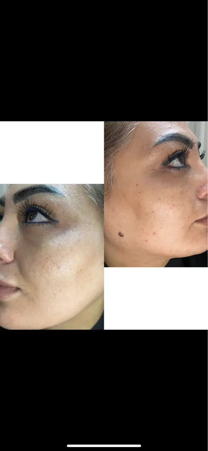 رفع لک و تیرگی صورت و بدن|آرایشی، بهداشتی، درمانی|پاکدشت, پاکدشت (مامازند)|دیوار