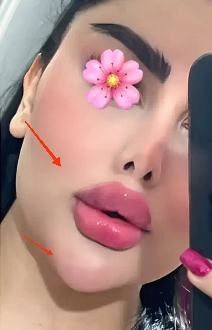 جشنواره50% ژل بوتاکس آنزیم خال مزو زگیل لابیا زگیل|خدمات آرایشگری و زیبایی|کرمانشاه, |دیوار