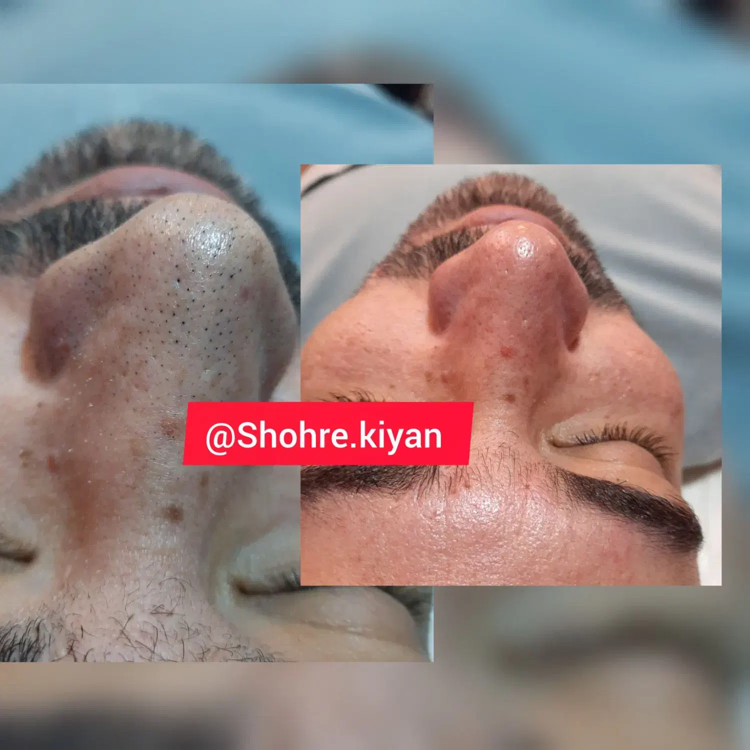پاکسازی پوست|خدمات آرایشگری و زیبایی|اصفهان, شهرک سلامت|دیوار
