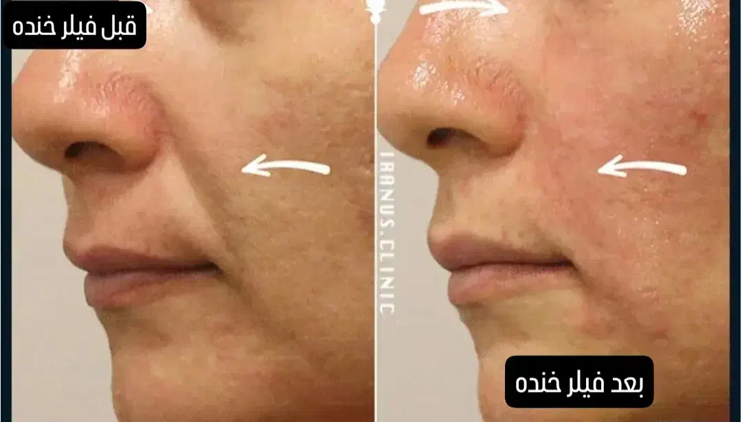 بوتاکس جوانساز آنزیم فیلر|خدمات آرایشگری و زیبایی|ملایر, |دیوار